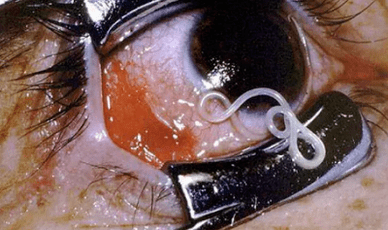 Tipos de parasitas no corpo humano